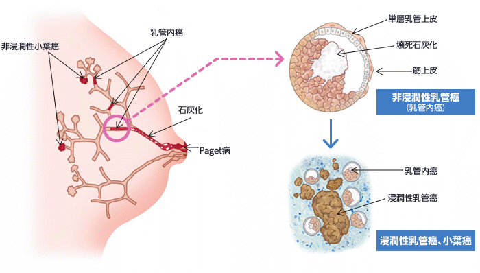 乳がんの病理診断結果の読み方について | 