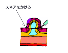 図：スネアをかける