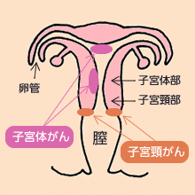 図：子宮がんのできる場所
